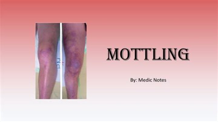 Can mottling come and go?