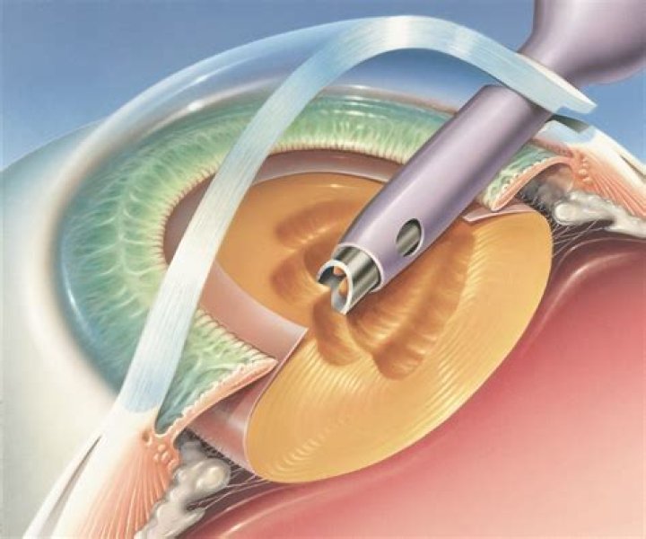 Who invented cataract surgery?